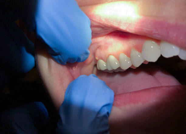 Best Emergency Tooth Extraction in Marbleton, WY