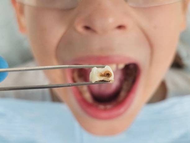 Best Emergency Tooth Extraction in Marbleton, WY